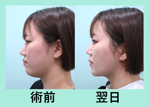 糸リフトアップ 東京 銀座の美容外科クリニックwom Clinic Ginza Part 2 糸リフトアップ 東京 銀座の美容外科クリニックwom Clinic Ginza Part 2