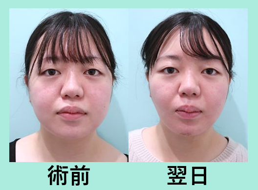 小顔 脂肪吸引 ダウンタイム