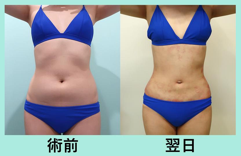 お腹、胸下、背中、腰の脂肪吸引、ベイザー_術後翌日ダウンタイム