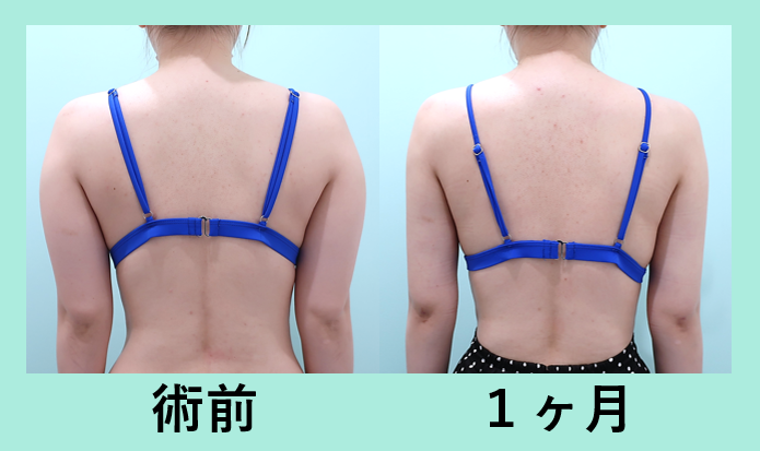 二の腕肩付け根脂肪吸引＋ベイザー_術後1ヶ月