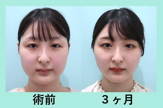 バッカルファット術 東京 銀座の美容外科クリニックwom Clinic Ginza Part 2 バッカルファット術 東京 銀座の美容外科クリニックwom Clinic Ginza Part 2