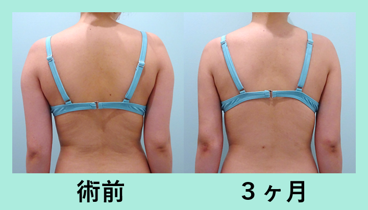 二の腕肩付け根脂肪吸引_術後3ヶ月
