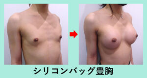 大きさ重視ならシリコンバッグ豊胸術です 東京 銀座の美容外科クリニックwom Clinic Ginza