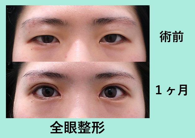 目頭切開 東京 銀座の美容外科クリニックwom Clinic Ginza 目頭切開 東京 銀座の美容外科クリニックwom Clinic Ginza