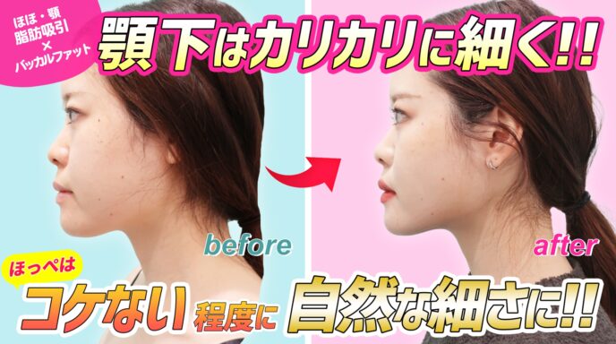小顔マイクロリポ法 東京 銀座の美容外科クリニックwom Clinic Ginza 小顔マイクロリポ法 東京 銀座の美容外科クリニックwom Clinic Ginza