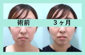 『顔の脂肪再配置 WOM CLINIC ならではの高度な組み合わせ治療』の画像