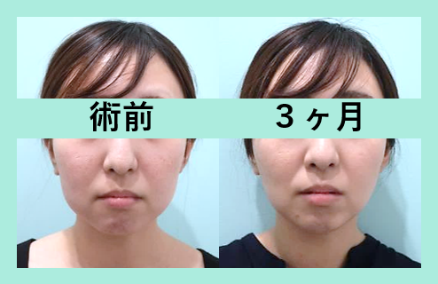 頬こけ脂肪注入 東京 銀座の美容外科クリニックwom Clinic Ginza