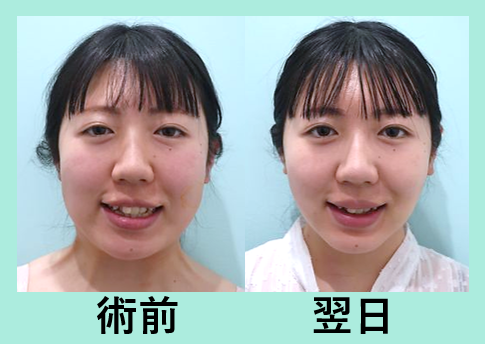 糸リフトアップ 東京 銀座の美容外科クリニックwom Clinic Ginza Part 2 糸リフトアップ 東京 銀座の美容外科クリニックwom Clinic Ginza Part 2