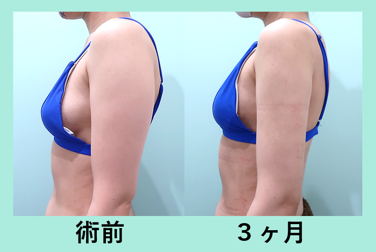 二の腕 カリッカリに細く 東京 銀座の美容外科クリニックwom Clinic Ginza