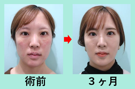 脂肪吸引量 少なめ 多め 標準 果たして結果の違いは ３人分まとめてご紹介 東京 銀座の美容外科クリニックwom Clinic Ginza