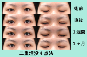 腫れぼったい瞼をきれいな目元にするには 東京 銀座の美容外科クリニックwom Clinic Ginza 腫れぼったい瞼をきれいな目元にするには 東京 銀座の美容外科クリニックwom Clinic Ginza