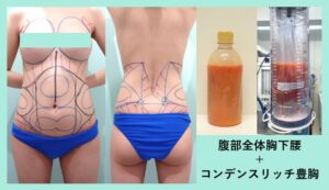 『腹部～腰の芸術的な脂肪吸引とコンデンスリッチ(CRF)豊胸』の画像
