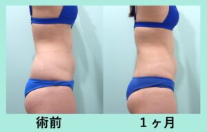『腰だけの脂肪吸引 ３０万円 でここまで変われる！！』の画像