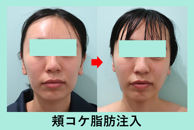 顔痩せ 頬コケ には脂肪注入がオススメです 東京 銀座の美容外科クリニックwom Clinic Ginza