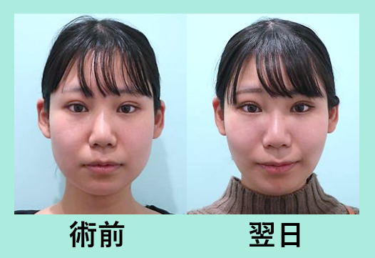 顎が出るとイケメンになる 東京 銀座の美容外科クリニックwom Clinic Ginza 顎が出るとイケメンになる 東京 銀座の美容外科クリニックwom Clinic Ginza