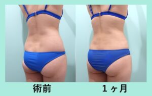 『腰だけの脂肪吸引 ３０万円 でここまで変われる！！』の画像