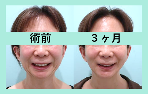 頬と顎下の脂肪吸引＋糸リフト_術後3ヶ月ダウンタイム