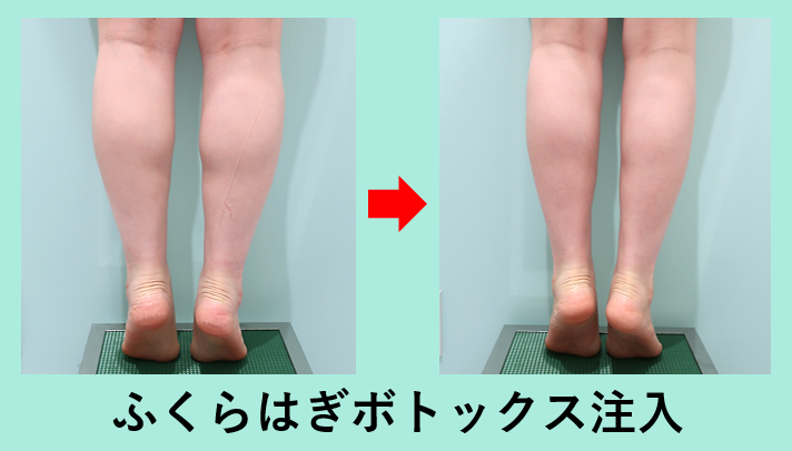 筋肉質なふくらはぎにはボトックス注射 東京 銀座の美容外科クリニック Wom Clinic Ginza