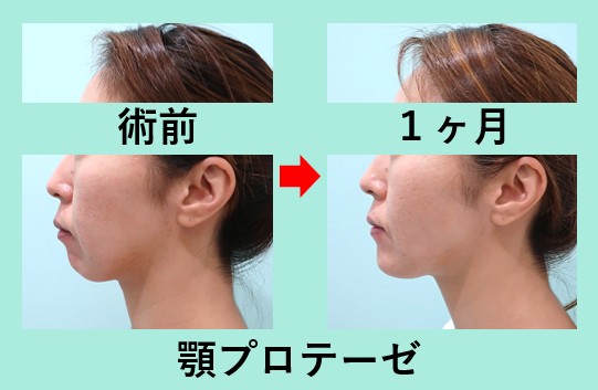 顎プロテーゼ、顔の脂肪吸引_1ヶ月、ダウンタイム、横顔