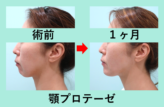 顎プロテーゼの威力をご覧ください ダウンタイムもほとんどなし 東京 銀座の美容外科クリニックwom Clinic Ginza