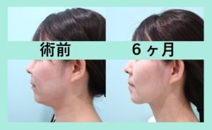 『超高度テクニック！ 頬顎メーラーのコンビネーション治療』の画像