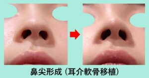 『鼻先を整える「鼻尖形成術」は非常に繊細な手術です。』の画像