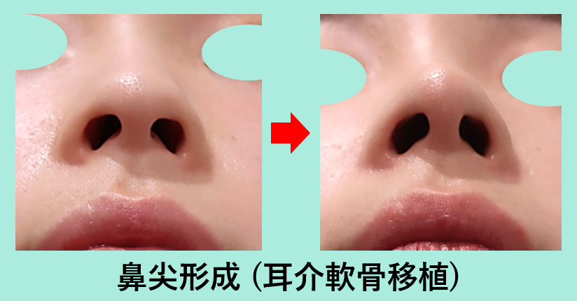 鼻尖形成＋耳介軟骨移植_ビフォーアフター