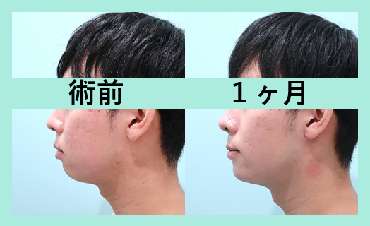 顎プロテーゼ、顔の脂肪吸引_1ヶ月、ダウンタイム、横顔