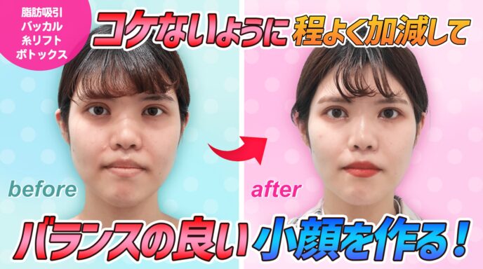 小顔マイクロリポ法 東京 銀座の美容外科クリニックwom Clinic Ginza 小顔マイクロリポ法 東京 銀座の美容外科クリニックwom Clinic Ginza