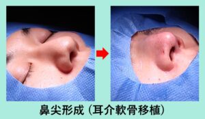 『耳介軟骨移植を併用した「 鼻尖形成術 」』の画像