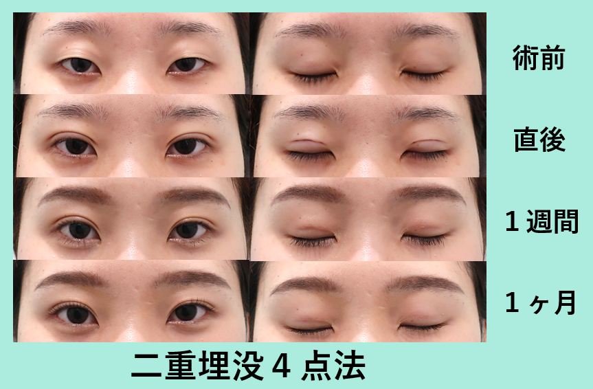 埋没4点法_術後1ヶ月ダウンタイム