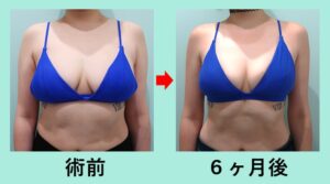 『「 副乳・脇肉・胸下 」のレアな部位の脂肪吸引で全体的なバランスを整える！』の画像