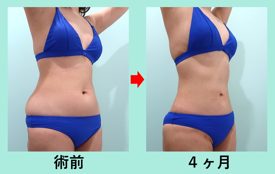 腹部全体脂肪吸引＋胸下脂肪吸引＋腰脂肪吸引_術後4ヶ月