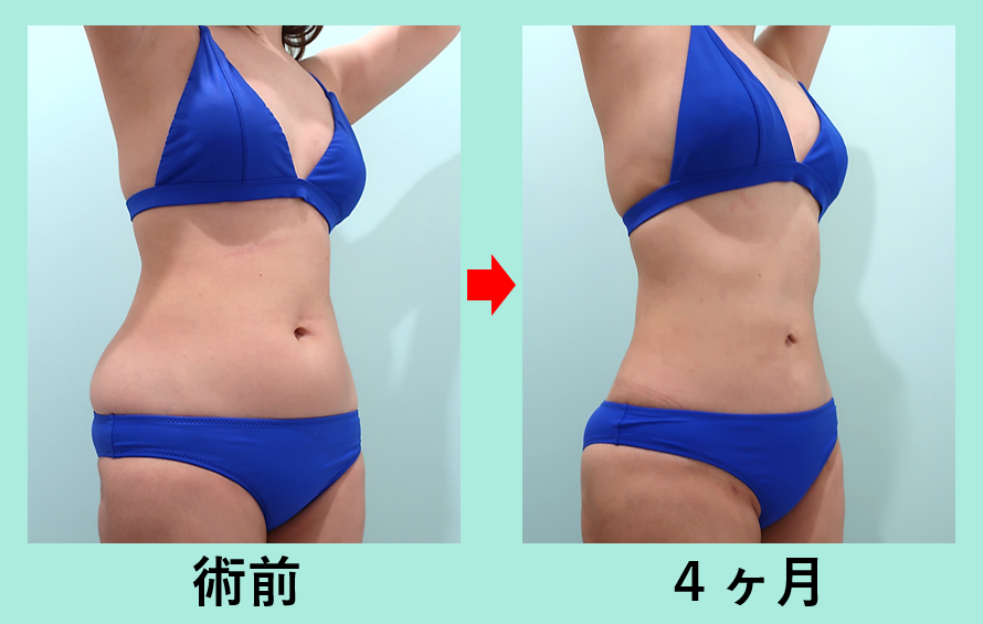 腹部全体脂肪吸引+胸下脂肪吸引+腰脂肪吸引_術後4ヶ月