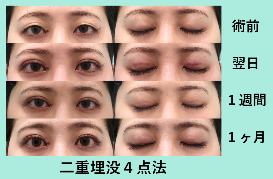 二重埋没4点法_術後1ヶ月ダウンタイム、平行
