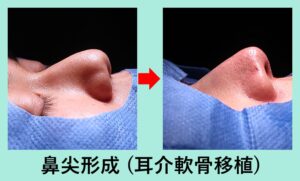 『耳介軟骨移植を併用した「 鼻尖形成術 」』の画像