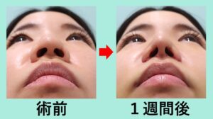 『実録！鼻尖形成と人中短縮の組み合わせで理想の鼻に！』の画像