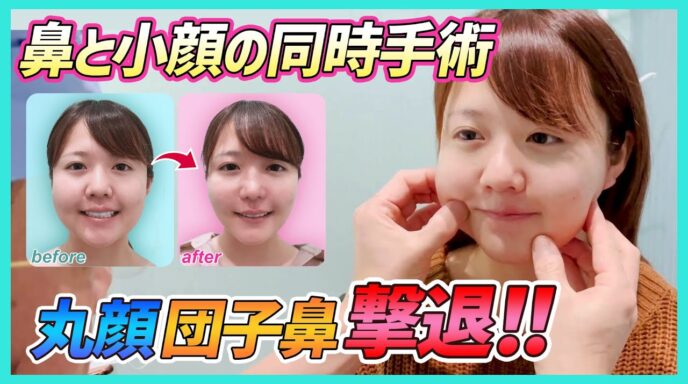 鼻形成 東京 銀座の美容外科クリニックwom Clinic Ginza 鼻形成 東京 銀座の美容外科クリニックwom Clinic Ginza