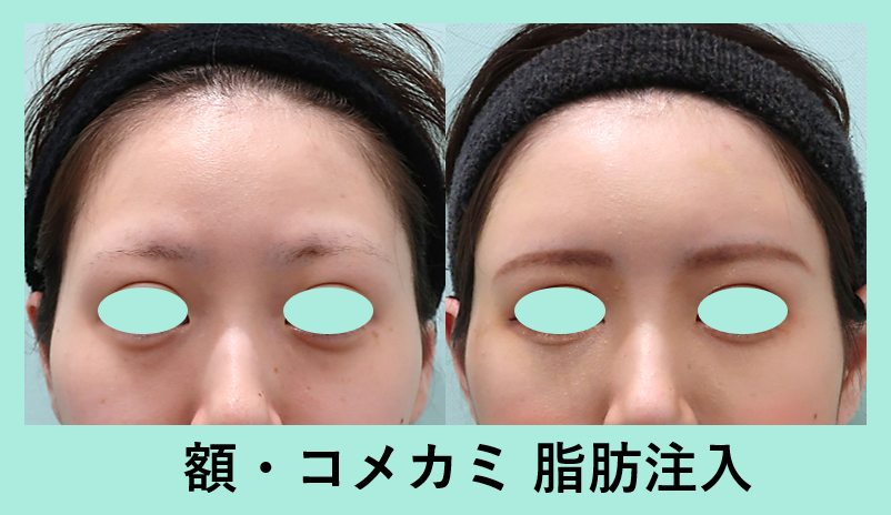 額脂肪注入+コメカミ脂肪注入_激変