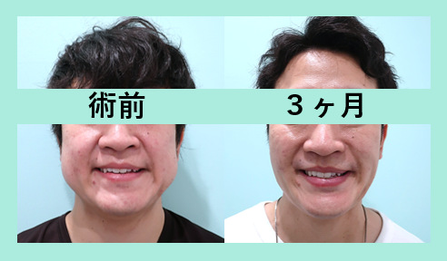 男性の小顔治療が人気です 耳下腺ボトックス併用で効果抜群に 東京 銀座の美容外科クリニック Wom Clinic Ginza 男性の小顔治療が人気です 耳下腺ボトックス併用で効果抜群に 東京 銀座の美容外科クリニック Wom Clinic Ginza