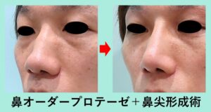 『鼻手術の一番人気 「鼻尖形成術」＋「プロテーゼ」』の画像
