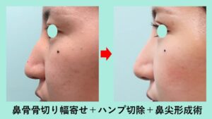『骨切り・鼻尖形成（クローズド法）で大きな鼻をエレガントな鼻に！』の画像