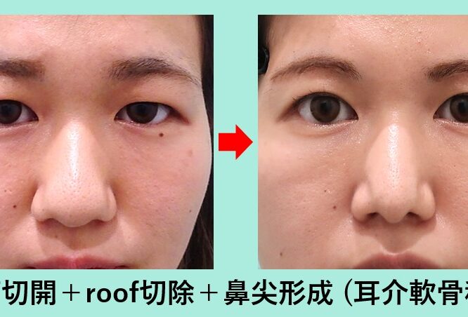 眉下切開＋roof切除_鼻尖形成_ビフォーアフター