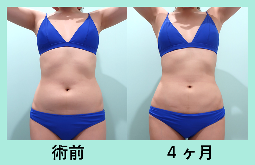 腹部全体脂肪吸引＋胸下脂肪吸引＋腰脂肪吸引_術後4ヶ月ダウンタイム