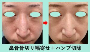 『【 鼻の骨切り手術 】どんな変化があるのか？ ビフォーアフターを検証！』の画像