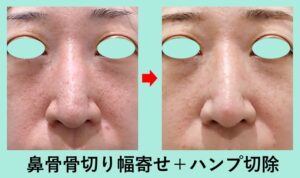 『【 鼻の骨切り手術 】どんな変化があるのか？ ビフォーアフターを検証！』の画像