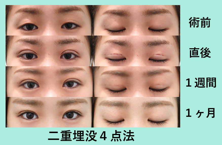 二重埋没4点法_術後1ヶ月ダウンタイム_自然