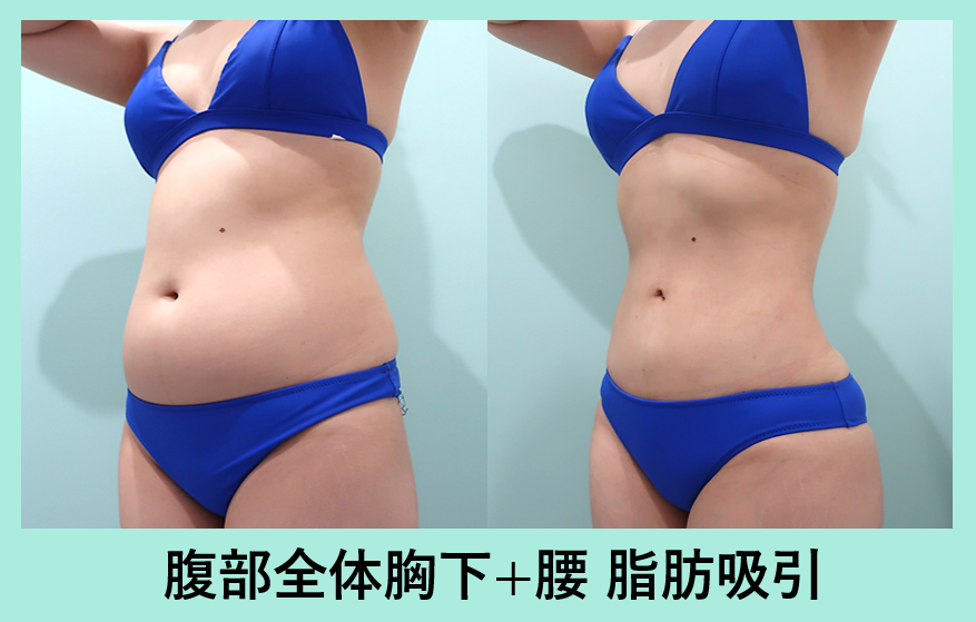 腹部全体脂肪吸引+胸下脂肪吸引+腰脂肪吸引_術後ダウンタイム