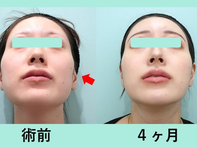 頬こけ脂肪注入 東京 銀座の美容外科クリニックwom Clinic Ginza 頬こけ脂肪注入 東京 銀座の美容外科クリニックwom Clinic Ginza