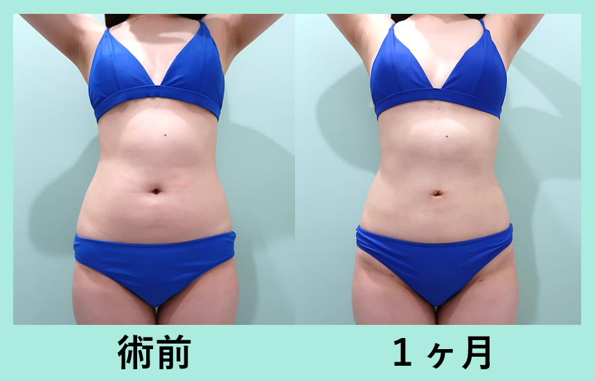 腹部全体脂肪吸引+胸下脂肪吸引_ベイザー_術後1ヶ月ダウンタイム